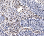 IHC staining of FFPE human lung cancer tissue with GFPT1 antibody. HIER: boil tissue sections in pH8 EDTA for 20 min and allow to cool before testing.