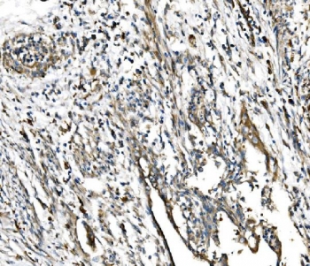 IHC staining of FFPE human cervical cancer tissue with GFPT1 antibody. HIER: boil tissue sections in pH8 EDTA for 20 min and allow to cool before testing.