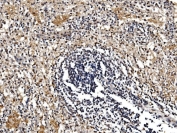IHC staining of FFPE human splenic rupture tissue with GFPT1 antibody. HIER: boil tissue sections in pH8 EDTA for 20 min and allow to cool before testing.