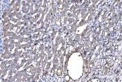 IHC staining of FFPE human liver cancer tissue with GFPT1 antibody. HIER: boil tissue sections in pH8 EDTA for 20 min and allow to cool before testing.