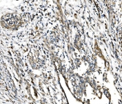 IHC staining of FFPE human cervical cancer tissue with GFPT1 antibody. HIER: boil tissue sections in pH8 EDTA for 20 min and allow to cool before testing.