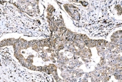 IHC staining of FFPE human adenocarcinoma of the right colon with GRHL2 antibody. HIER: boil tissue sections in pH8 EDTA for 20 min and allow to cool before testing.