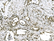 IHC staining of FFPE human stomach cancer tissue with GRHL2 antibody. HIER: boil tissue sections in pH8 EDTA for 20 min and allow to cool before testing.
