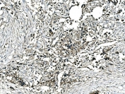 IHC staining of FFPE human breast cancer tissue with GRHL2 antibody. HIER: boil tissue sections in pH8 EDTA for 20 min and allow to cool before testing.