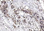 IHC staining of FFPE human breast cancer tissue with IMPDH1 antibody. HIER: boil tissue sections in pH8 EDTA for 20 min and allow to cool before testing.