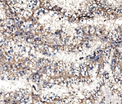 IHC staining of FFPE human renal cell carcinoma tissue with IMPDH1 antibody. HIER: boil tissue sections in pH8 EDTA for 20 min and allow to cool before testing.