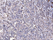 IHC staining of FFPE human lymphoma tissue with IMPDH1 antibody. HIER: boil tissue sections in pH8 EDTA for 20 min and allow to cool before testing.
