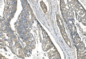 IHC staining of FFPE human colon adenocarcinoma tissue with IMPDH1 antibody. HIER: boil tissue sections in pH8 EDTA for 20 min and allow to cool before testing.