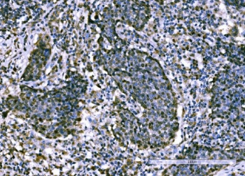 IHC staining of FFPE human lung cancer tissue with Importin subunit alpha-1 antibody. HIER: boil tissue sections in pH8 EDTA for 20 min and allow to cool before testing.