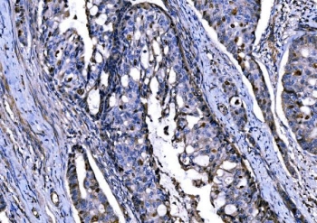 IHC staining of FFPE human adenocarcinoma of the right colon with Importin subunit alpha-1 antibody. HIER: boil tissue sections in pH8 EDTA for 20 min and allow to cool before testing.