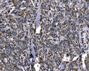 IHC staining of FFPE human lymphoma tissue with Importin subunit alpha-1 antibody. HIER: boil tissue sections in pH8 EDTA for 20 min and allow to cool before testing.