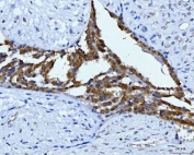 IHC staining of FFPE human breast cancer tissue with Keratin 7 antibody. HIER: boil tissue sections in pH8 EDTA for 20 min and allow to cool before testing.