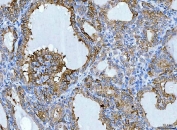 IHC staining of FFPE human thyroid cancer tissue with Keratin 7 antibody. HIER: boil tissue sections in pH8 EDTA for 20 min and allow to cool before testing.
