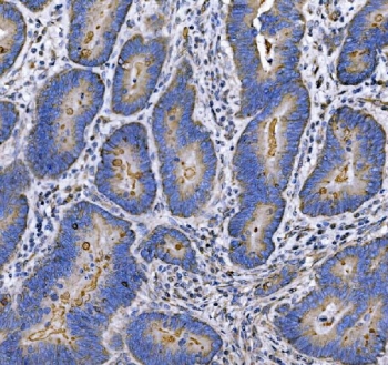 IHC staining of FFPE moderately differentiated adenocarcinoma of the human r