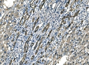 IHC staining of FFPE human liver cancer tissue with NEDD4 antibody. HIER: boil tissue sections in pH8 EDTA for 20 min and allow to cool before testing.