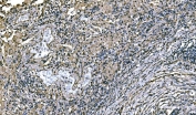 IHC staining of FFPE human lung cancer tissue with NEDD4 antibody. HIER: boil tissue sections in pH8 EDTA for 20 min and allow to cool before testing.