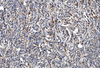 IHC staining of FFPE human lymphoma tissue with NLRP7 antibody. HIER: boil tissue sections in pH8 EDTA for 20 min and allow to cool before testing.