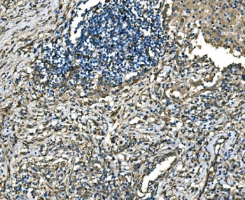 IHC staining of FFPE human lung cancer tissue with RAB13 antibody. HIER: boil tissue sections in pH8 EDTA for 20 min and allow to cool before testing.