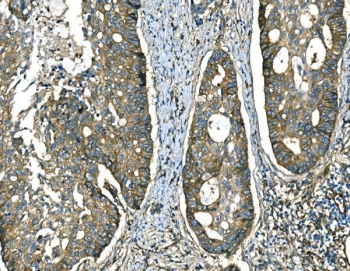 IHC staining of FFPE human adenocarcinoma of the right colon with RAB13 antibody. HIER: boil tissue sections in pH8 EDTA for 20 min and allow to cool before testing.