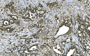 IHC staining of FFPE human stomach cancer tissue with RAB13 antibody. HIER: boil tissue sections in pH8 EDTA for 20 min and allow to cool before testing.