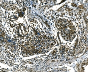 IHC staining of FFPE human cervical cancer tissue with RAB13 antibody. HIER: boil tissue sections in pH8 EDTA for 20 min and allow to cool before testing.