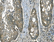IHC staining of FFPE human adenocarcinoma of the right colon with RAB13 antibody. HIER: boil tissue sections in pH8 EDTA for 20 min and allow to cool before testing.