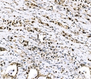 IHC staining of FFPE human stomach cancer tissue with RRS1 antibody. HIER: boil tissue sections in pH8 EDTA for 20 min and allow to cool before testing.