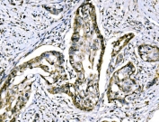 IHC staining of FFPE human adenocarcinoma of the right colon with RRS1 antibody. HIER: boil tissue sections in pH8 EDTA for 20 min and allow to cool before testing.