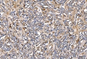IHC staining of FFPE human lymphoma tissue with SERPINF2 antibody. HIER: boil tissue sections in pH8 EDTA for 20 min and allow to cool before testing.