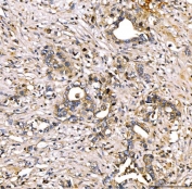 IHC staining of FFPE human stomach cancer tissue with SERPINF2 antibody. HIER: boil tissue sections in pH8 EDTA for 20 min and allow to cool before testing.