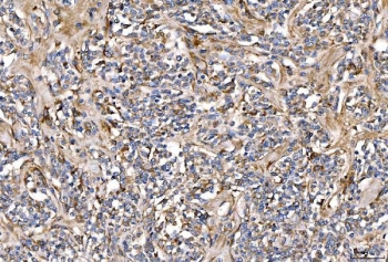 IHC staining of FFPE human lymphoma tissue with SERPINF2 antibody. HIER: boil tissue sections in pH8 EDTA for 20 min and allow to cool before testing.