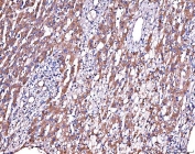 IHC staining of FFPE human liver cancer tissue with SERPINF2 antibody. HIER: boil tissue sections in pH8 EDTA for 20 min and allow to cool before testing.