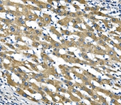 IHC staining of FFPE human liver cancer with Sigma1-receptor antibody. HIER: boil tissue sections in pH8 EDTA for 20 min and allow to cool before testing.