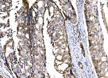 IHC staining of FFPE human adenocarcinoma of the right colon with Sigma1-receptor antibody. HIER: boil tissue sections in pH8 EDTA for 20 min and allow to cool before testing.