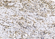 IHC staining of FFPE human stomach cancer tissue with Sigma1-receptor antibody. HIER: boil tissue sections in pH8 EDTA for 20 min and allow to cool before testing.