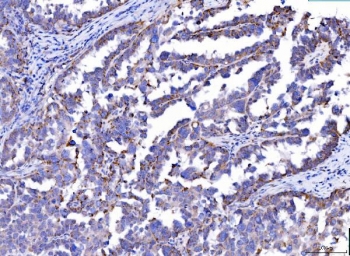 IHC staining of FFPE human serous adenocarcinoma of ovary tissue with MCART1/2 antibody. HIER: boil tissue sections in pH8 EDTA for 20 min and allow to cool before testing.