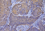 IHC staining of FFPE human laryngeal squamous cell carcinoma tissue with MCART1/2 antibody. HIER: boil tissue sections in pH8 EDTA for 20 min and allow to cool before testing.
