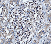 IHC staining of FFPE human lymphoma tissue with SPI1 antibody. HIER: boil tissue sections in pH8 EDTA for 20 min and allow to cool before testing.