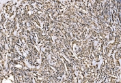 IHC staining of FFPE human lymphoma tissue with WAPL antibody. HIER: boil tissue sections in pH8 EDTA for 20 min and allow to cool before testing.