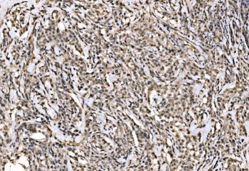 IHC staining of FFPE human lymphoma tissue with WAPL antibody. HIER: boil tissue sections in pH8 EDTA for 20 min and allow to cool before testing.