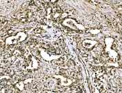 IHC staining of FFPE human stomach cancer tissue with WAPL antibody. HIER: boil tissue sections in pH8 EDTA for 20 min and allow to cool before testing.