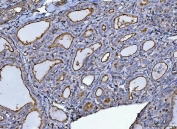 IHC staining of FFPE human thyroid cancer tissue with P Glycoprotein antibody. HIER: boil tissue sections in pH8 EDTA for 20 min and allow to cool before testing.