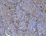 IHC staining of FFPE human liver cancer tissue with P Glycoprotein antibody. HIER: boil tissue sections in pH8 EDTA for 20 min and allow to cool before testing.