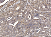 IHC staining of FFPE human colorectal cancer tissue with ACADM antibody. HIER: boil tissue sections in pH8 EDTA for 20 min and allow to cool before testing.