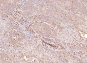 IHC staining of FFPE human laryngeal squamous cell carcinoma tissue with NDUFB8 antibody. HIER: boil tissue sections in pH8 EDTA for 20 min and allow to cool before testing.