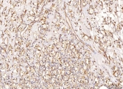 IHC staining of FFPE human renal clear cell carcinoma tissue with NDUFB8 antibody. HIER: boil tissue sections in pH8 EDTA for 20 min and allow to cool before testing.