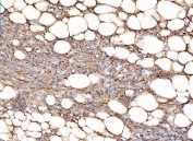 IHC staining of FFPE human smooth muscle fatty carcinoma of the left kidney tissue with NDUFB8 antibody. HIER: boil tissue sections in pH8 EDTA for 20 min and allow to cool before testing.