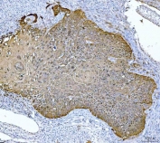 IHC staining of FFPE human laryngeal squamous cell carcinoma tissue with MASPIN antibody. HIER: boil tissue sections in pH8 EDTA for 20 min and allow to cool before testing.