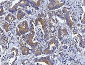 IHC staining of FFPE human colorectal adenocarcinoma tissue with HRS antibody. HIER: boil tissue sections in pH8 EDTA for 20 min and allow to cool before testing.