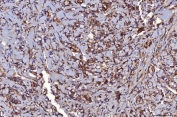 IHC staining of FFPE human breast infiltrating ductal carcinoma tissue with HRS antibody. HIER: boil tissue sections in pH8 EDTA for 20 min and allow to cool before testing.